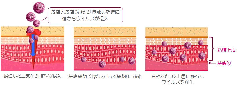 子宮頸癌ってどんな病気？ 子宮がん検診に行こう！