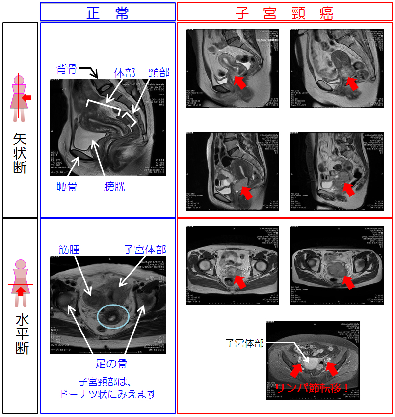 子宮頸癌の検査 2 画像検査 子宮がん検診に行こう