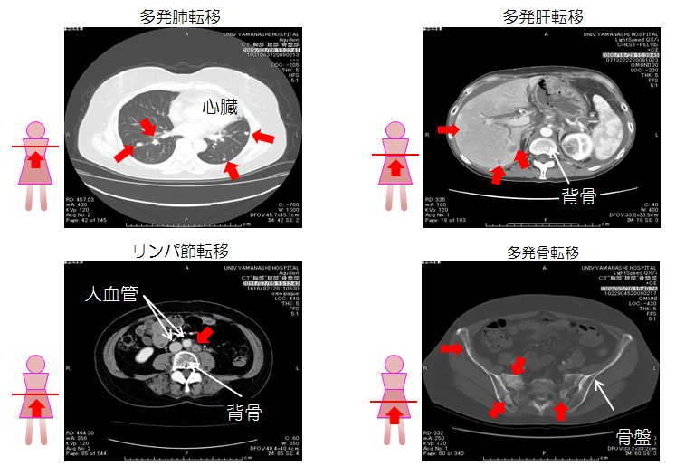 子宮頸癌の検査 2 画像検査 子宮がん検診に行こう