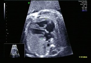 胎児先天性心疾患の出生前診断