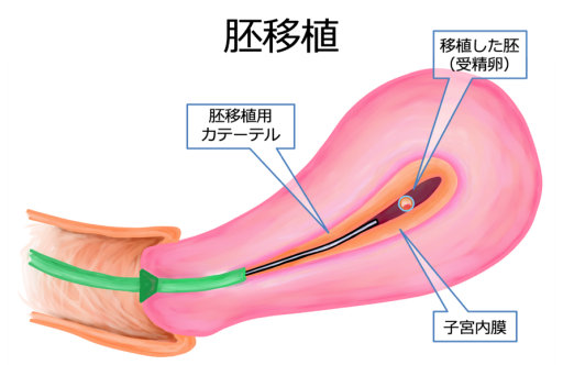 胚移植