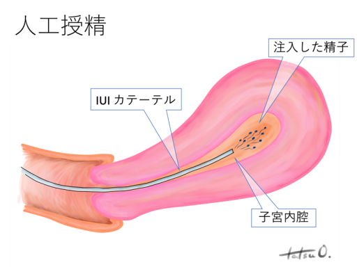 人工授精