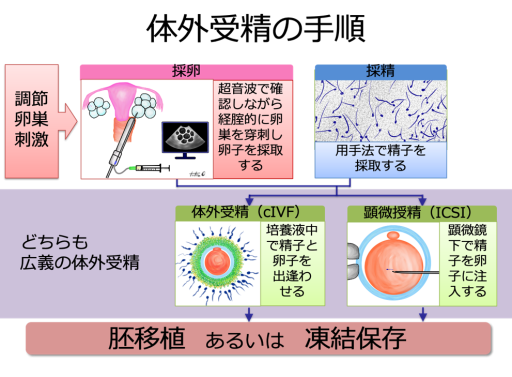 体外受精の手順